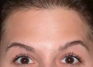 After Forehead Line — Poughkeepsie, NY — Wellness and Skincare Medical Center