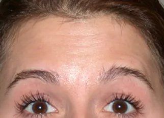 Before Forehead Line — Poughkeepsie, NY — Wellness and Skincare Medical Center