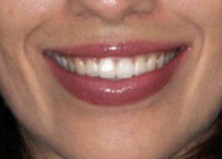 After Gummy Smile — Poughkeepsie, NY — Wellness and Skincare Medical Center