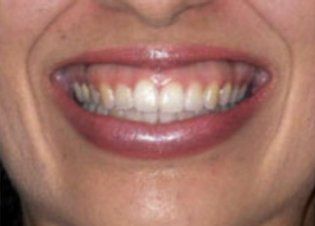 Before Gummy Smile — Poughkeepsie, NY — Wellness and Skincare Medical Center