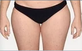 Before Inner Thigh and Outer Thigh​ — Poughkeepsie, NY — Wellness and Skincare Medical Center