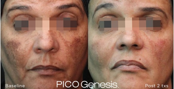 Man with Pico Genesis — Poughkeepsie, NY — Wellness and Skincare Medical Center