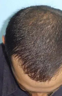 After Man Hair PRP — Poughkeepsie, NY — Wellness and Skincare Medical Center