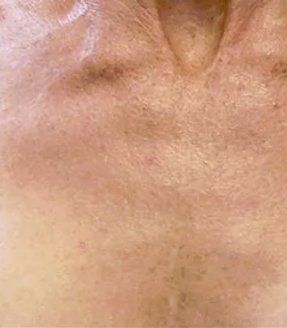 After Pigmentation Removal — Poughkeepsie, NY — Wellness and Skincare Medical Center
