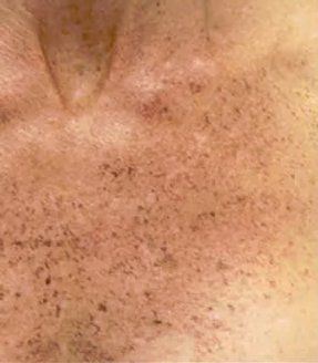 Before Pigmentation Removal — Poughkeepsie, NY — Wellness and Skincare Medical Center