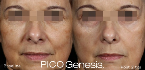 Woman with Pico Genesis — Poughkeepsie, NY — Wellness and Skincare Medical Center