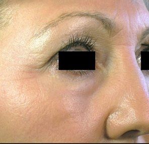After Wrinkles Around the Eyes — Poughkeepsie, NY — Wellness and Skincare Medical Center