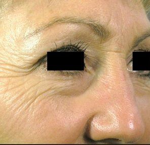 Before Wrinkles Around the Eyes — Poughkeepsie, NY — Wellness and Skincare Medical Center
