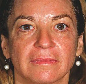 After Pelleve Face Lines — Poughkeepsie, NY — Wellness and Skincare Medical Center