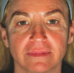 Before Pelleve Face Lines — Poughkeepsie, NY — Wellness and Skincare Medical Center
