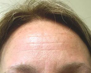 After Pelleve Forehead — Poughkeepsie, NY — Wellness and Skincare Medical Center