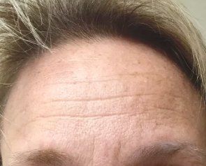 Before Pelleve Forehead — Poughkeepsie, NY — Wellness and Skincare Medical Center