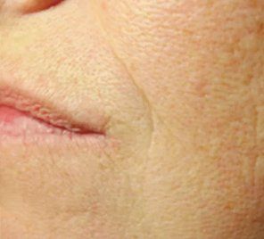 After Pelleve Smile Lines — Poughkeepsie, NY — Wellness and Skincare Medical Center