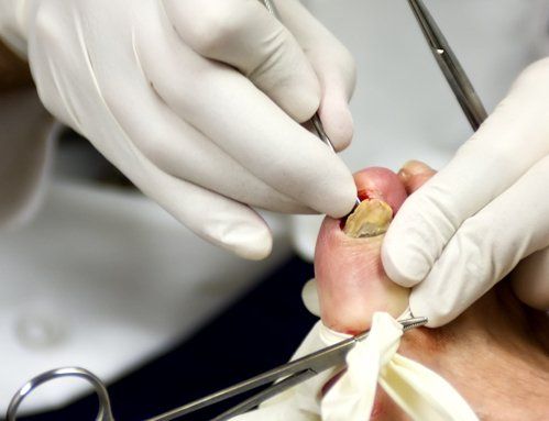 Podiatrist performing surgery on ingrown toenail