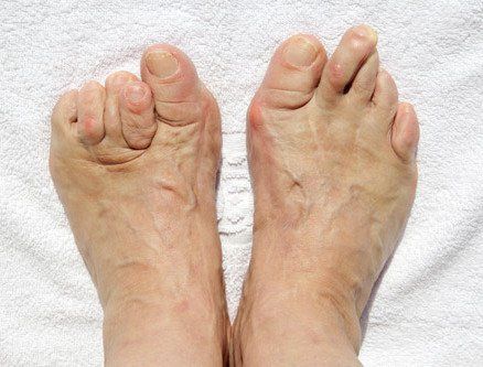 Hammertoe & other lesser toe Deformities