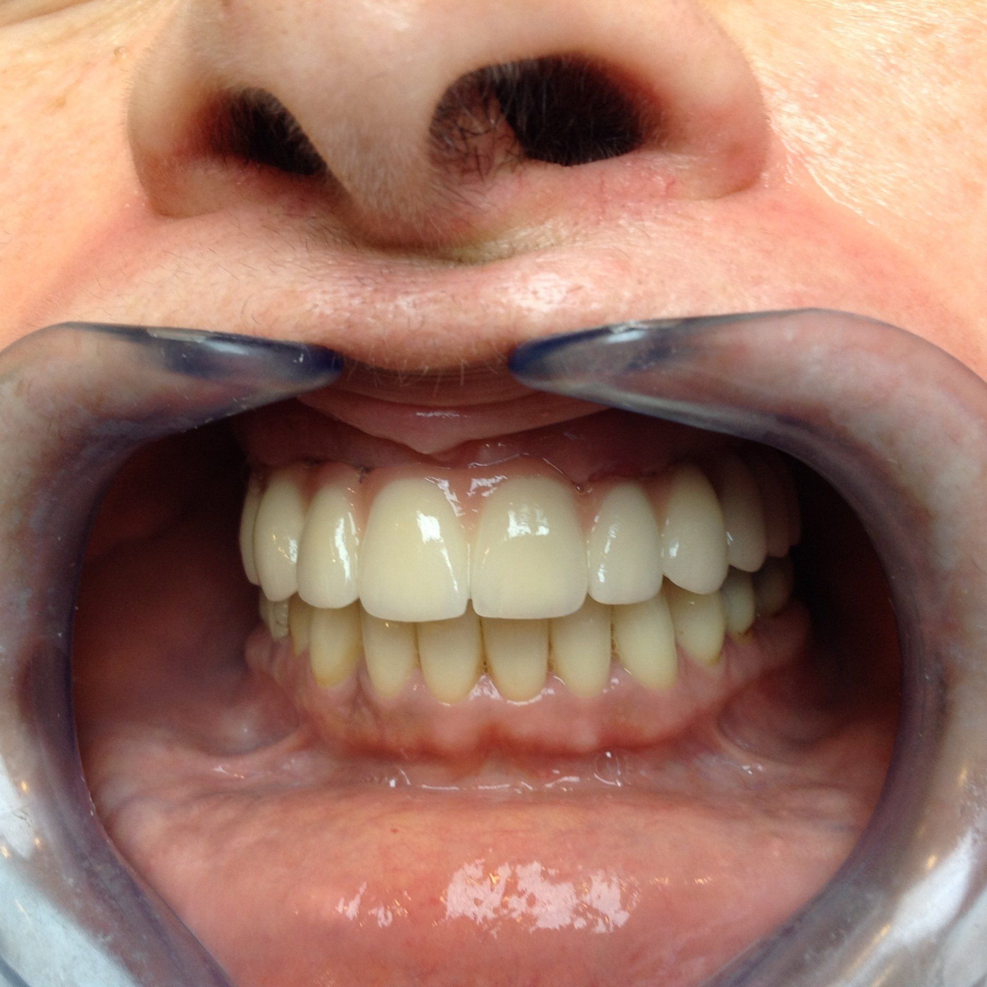 all on 6 dental implants after photo review