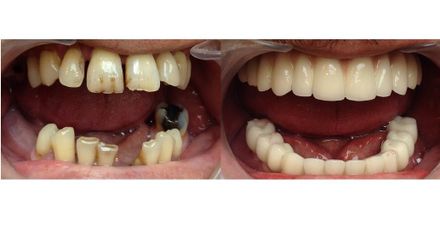 Full Mouth dental implant treatment Hungary