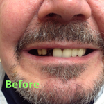 dental implants hungary before
