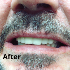 After Dental Implants Treatment in Hungary