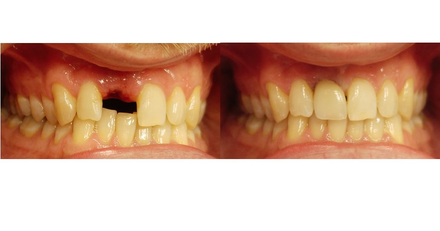 dental implant hungary