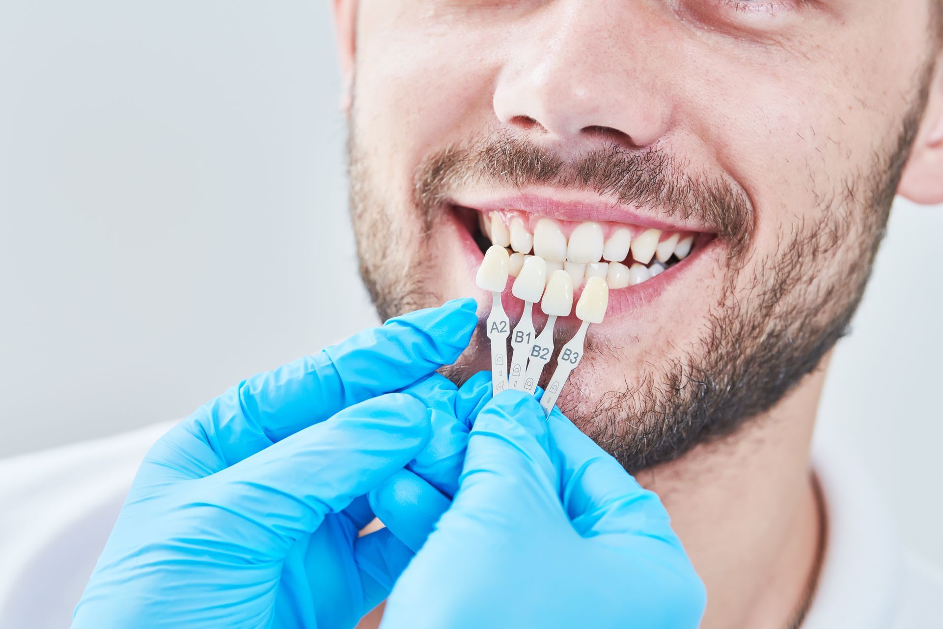 A close-up of a dentist matching the colour of a patient’s tooth enamel with a whitening chart.