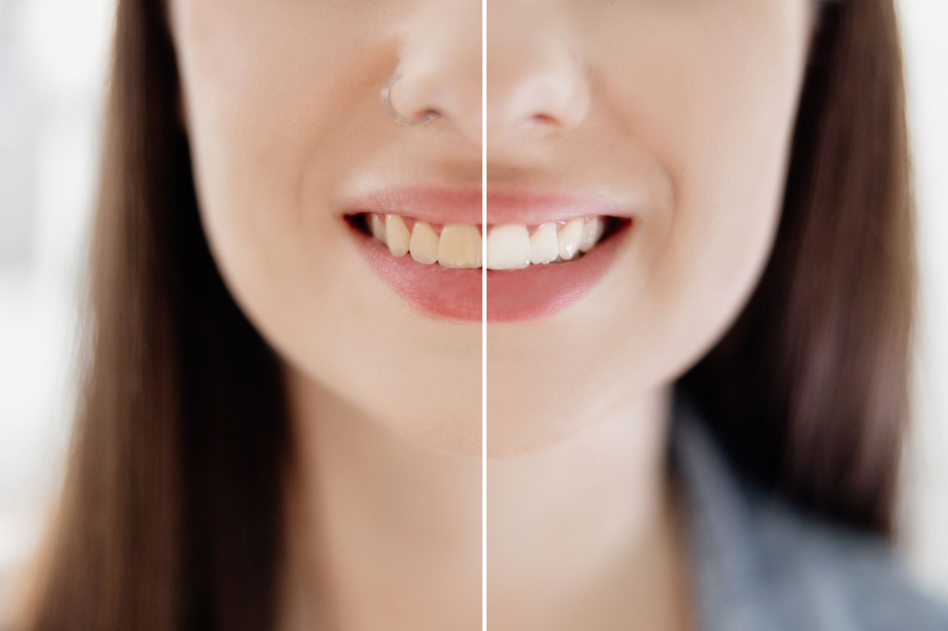 Woman Teeth Before & After Whitening — Mermaid Waters, QLD — Gold Coast Dental & Denture Centre