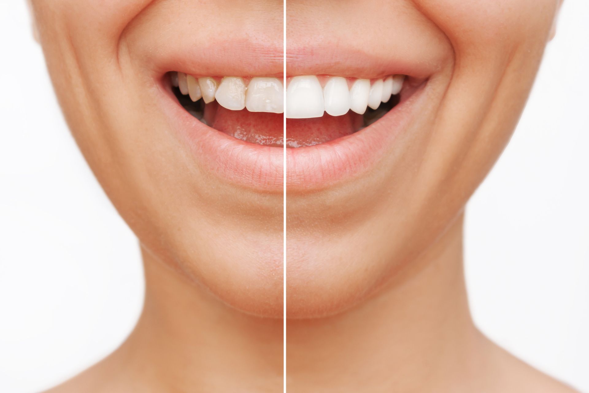 Comparison of a smiling person's teeth, the left side showing a natural color and the right side bright white.