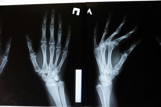 A close up of an x-ray of a hand and wrist.