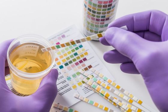 A person wearing purple gloves is holding a cup of urine and a test strip.