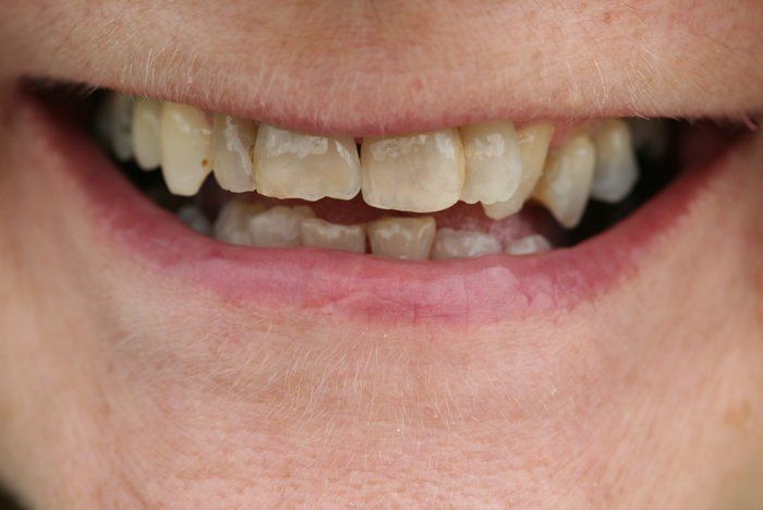 before smile makeover