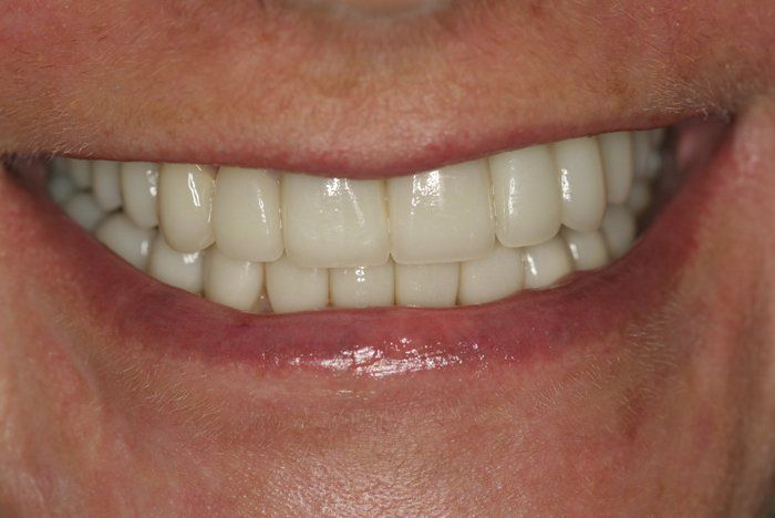 after smile makeover