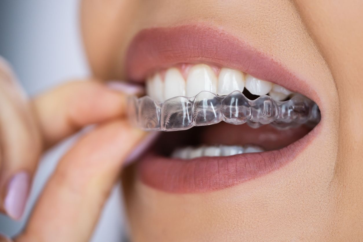 A woman is putting a clear brace on her teeth.