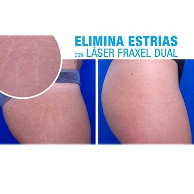 DRA. LORENA CHAPA G - tratamiento contra estrías