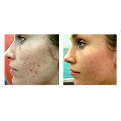 DRA. LORENA CHAPA G - láser co2 fraccionado