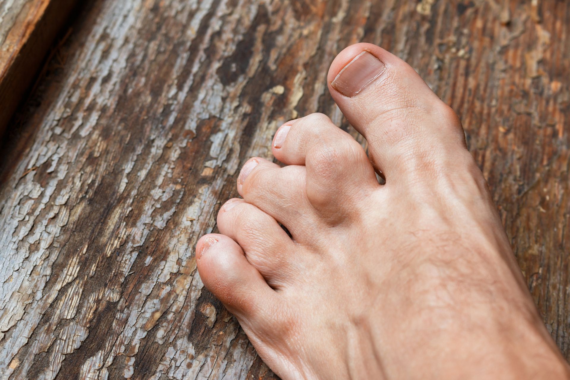 Foot with slightly swollen toes on a weathered wood surface.