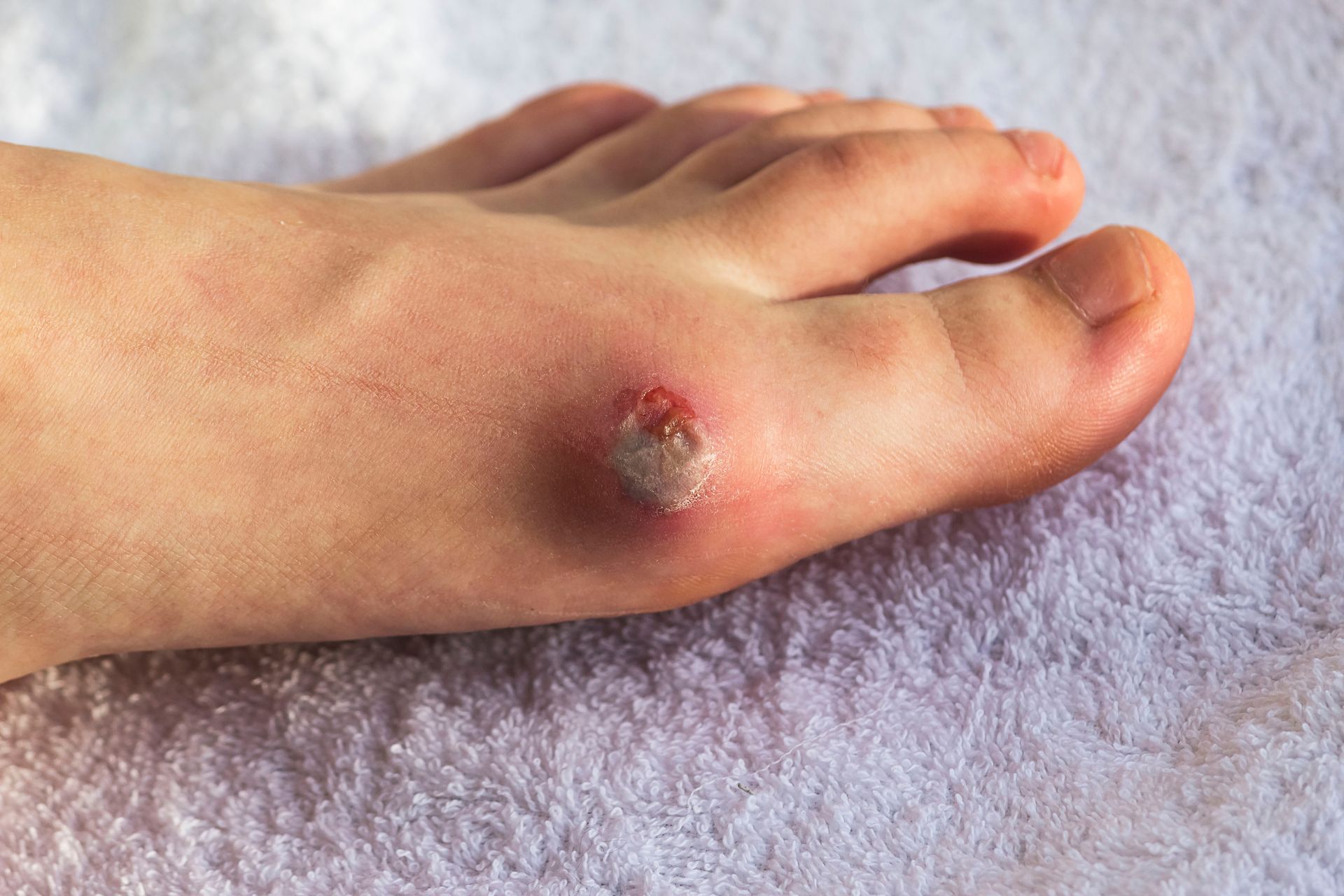 Foot with a red, raised bump and open sore on the big toe joint, lying on a white towel.