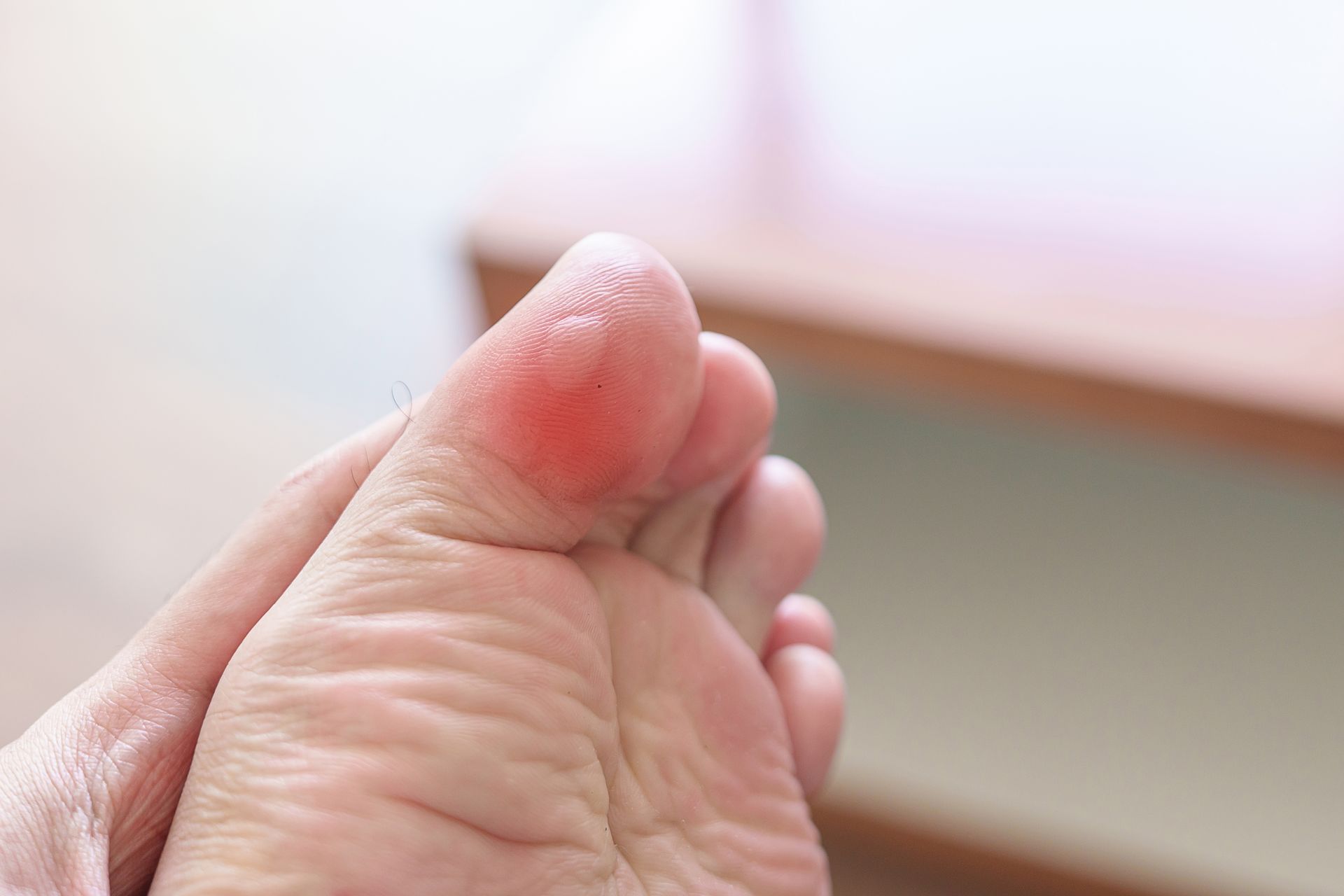 Foot with blister on toe, red and inflamed.