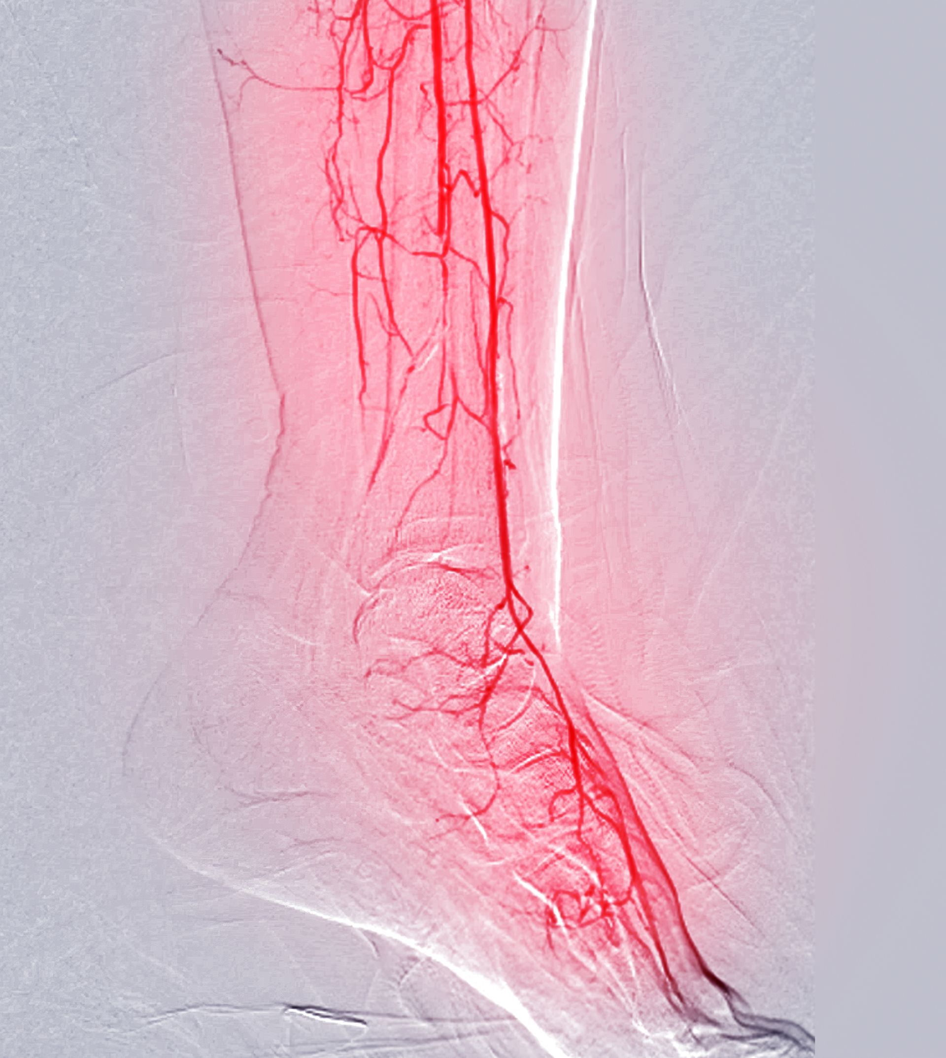 X-ray of leg and foot arteries highlighted in red, showing vascular structure.
