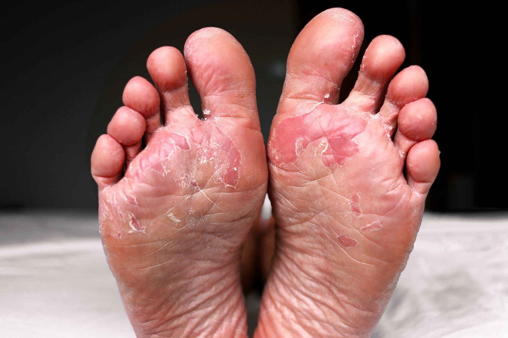 Soles of two feet; skin is peeling in patches, with some redness and damage visible.