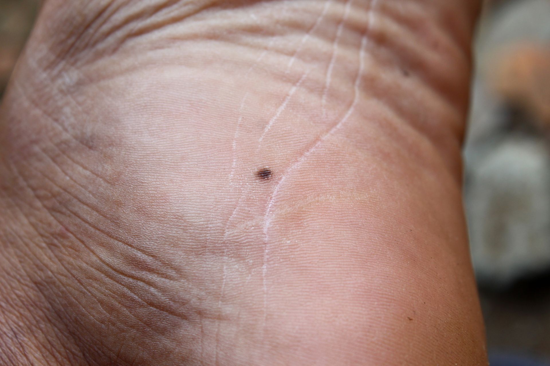 Close-up of a human foot with a small, dark mole on the skin.