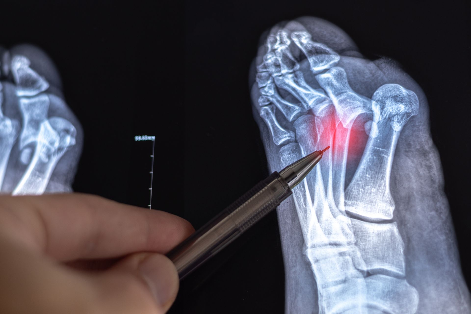 X-ray of foot with red highlighted area, hand pointing with a pen.
