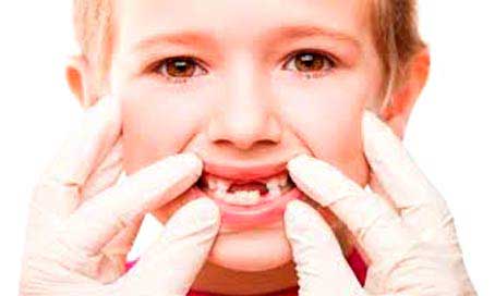 Dr. Antonio Alcázar Franco, Dentista Especialista en niños - Traumatismos dentofaciales