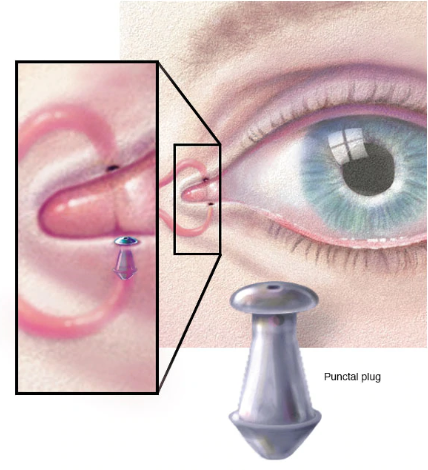 Punctal plugs for treating dry eye in Meridian and Boise ID 