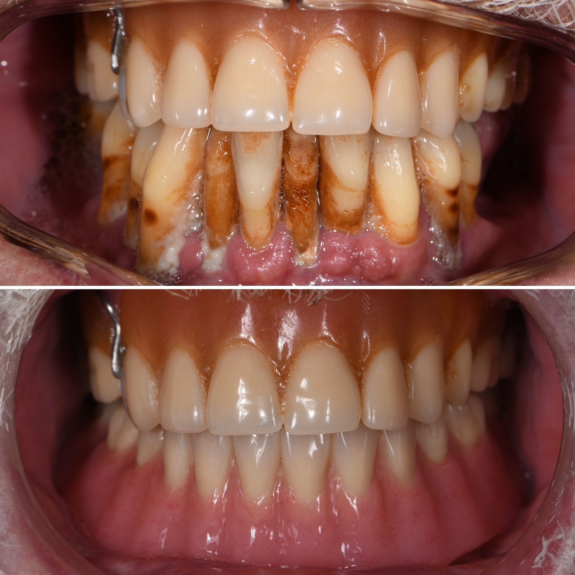 Before and After Smile of Dental Implants | Longmont CO Dentist