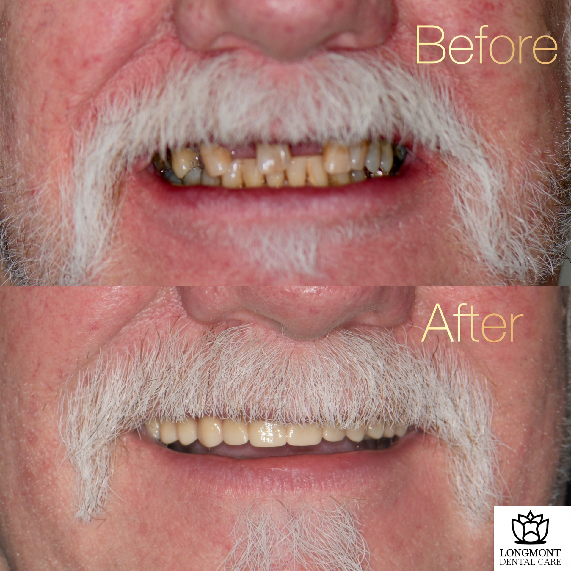 Before and After Dental Implants on Man | Dentist in Longmont CO