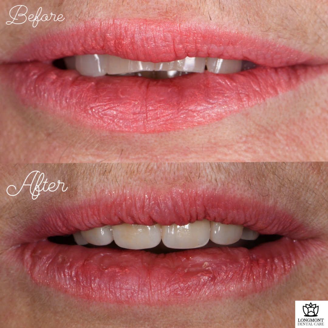 Before and After of Veneers and Dental Crowns | Longmont Dentist Smile Makeover
