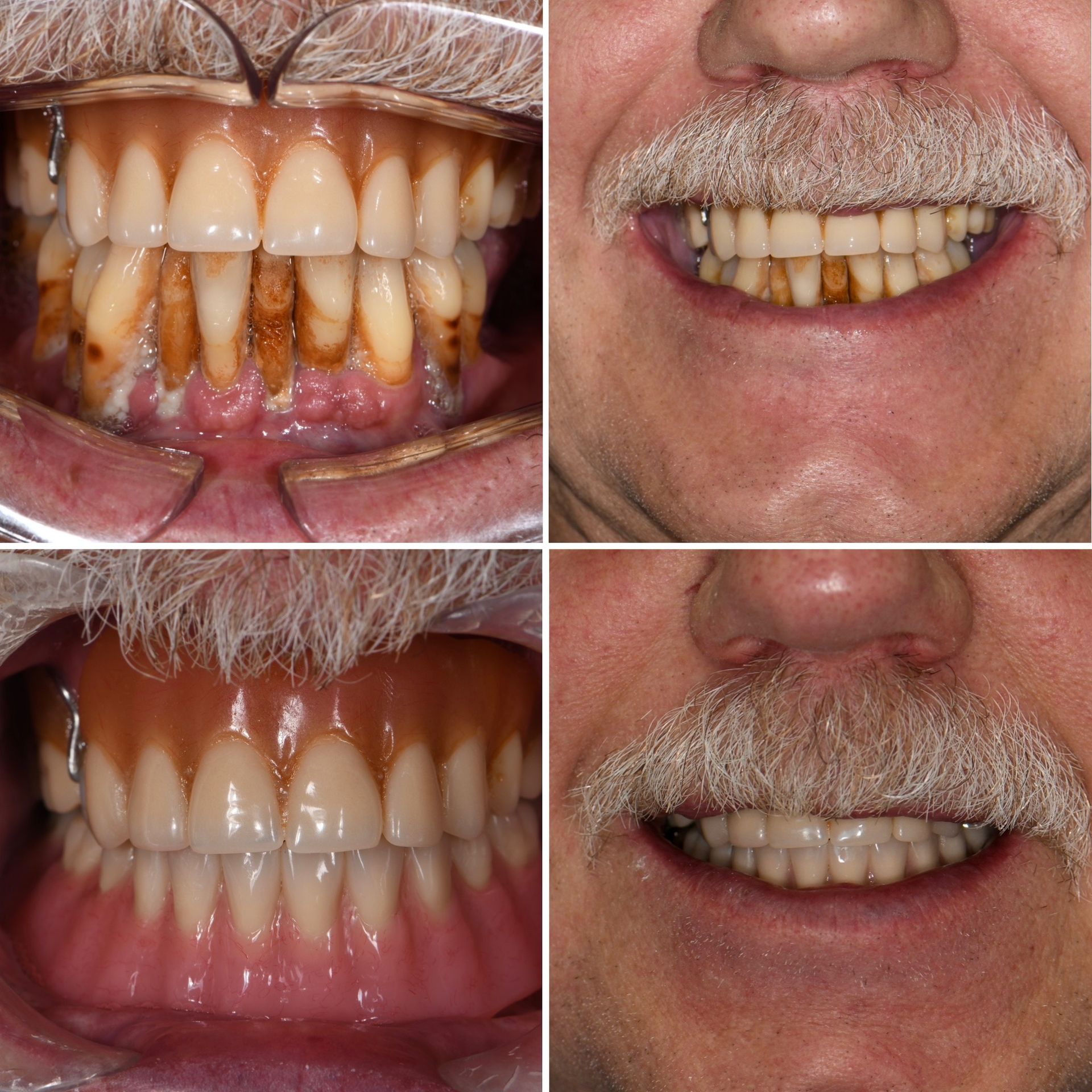 Before and After Photo of Man | Top Dentist in Longmont CO