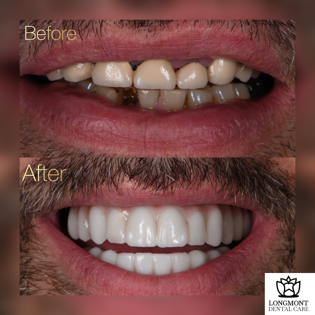 Man Smiling | Before and After of Dental Implants Longmont CO