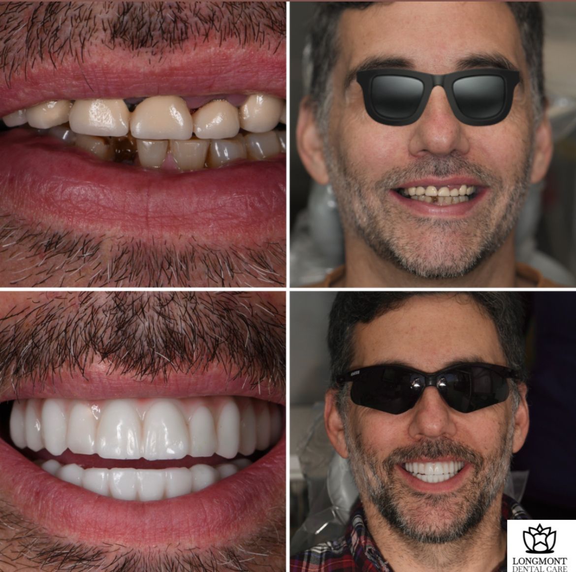 Before and After | Dental Implants | Family Dentist in Longmont CO