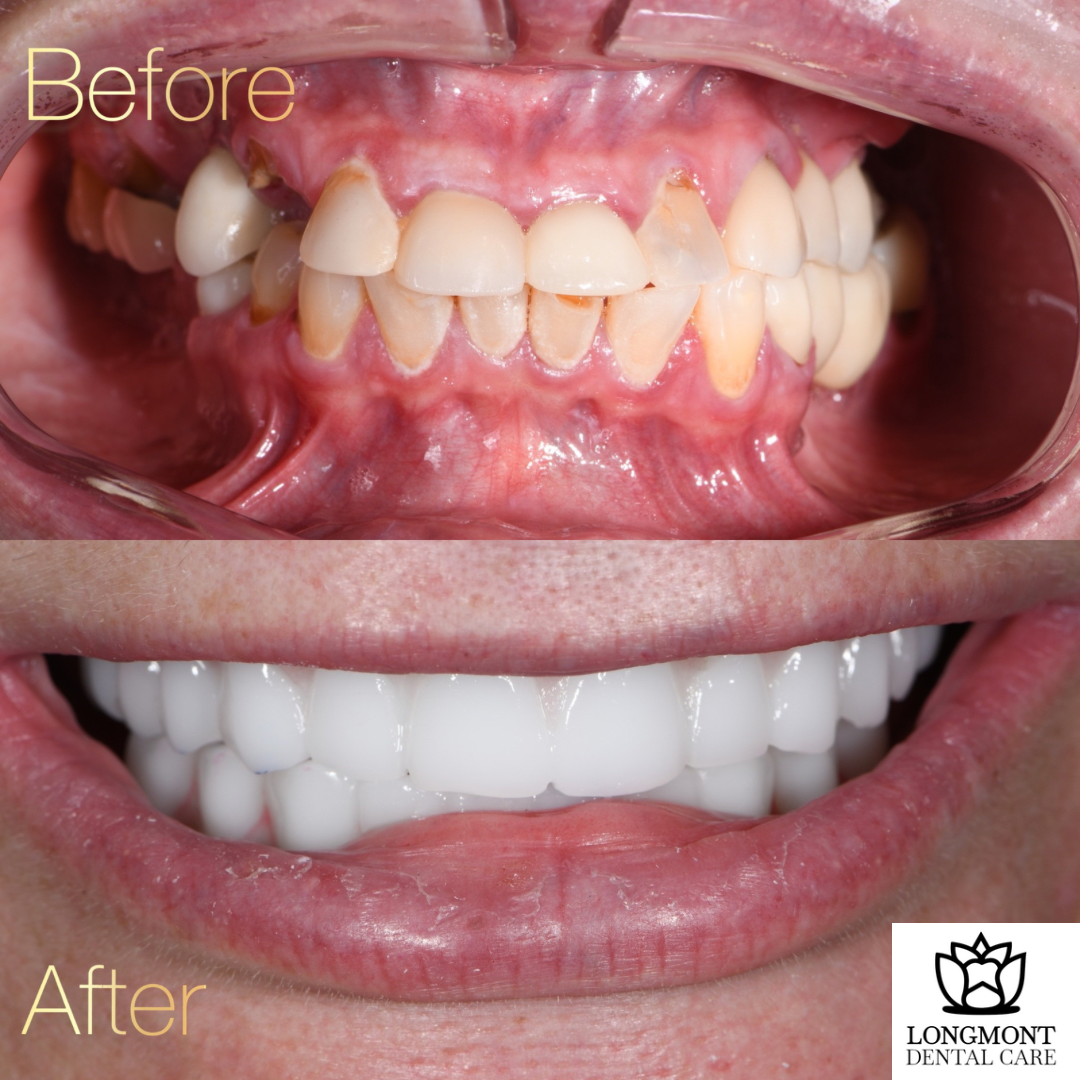 Before and After of Mouth with Dental Implants | Best Family Dentist Longmont CO